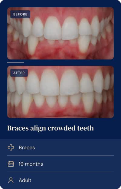 Crowding and uneven alignment corrected with braces, adult orthodontic case.