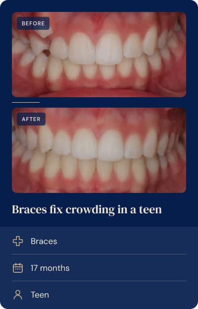 Significant rotation and crowding corrected with braces, teen orthodontic case.