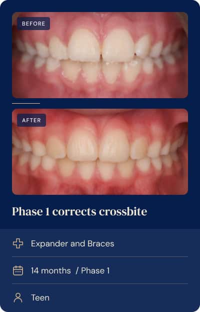 Narrow upper arch and crowding corrected with a palate expander and braces, Phase 1 teen case.