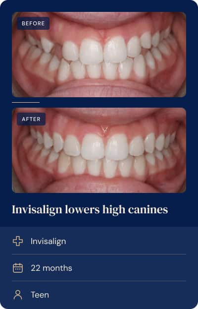 Impacted canines and a tight anterior bite corrected with Invisalign and rubber bands, teen case.