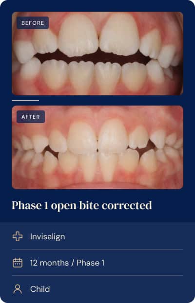Open bite corrected with Phase 1 Invisalign in a young child.