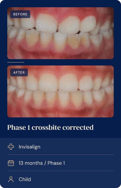 Significant overjet corrected with Phase 1 Invisalign in a child.