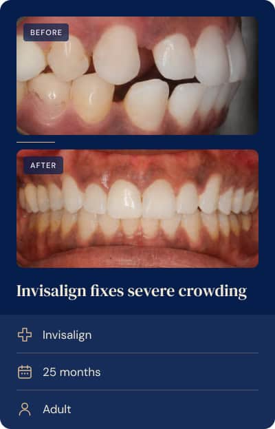 Overlapping, stacked front teeth aligned with Invisalign, adult orthodontic case.